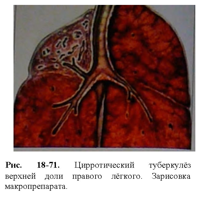 Цирротический туберкулез легких рисунок